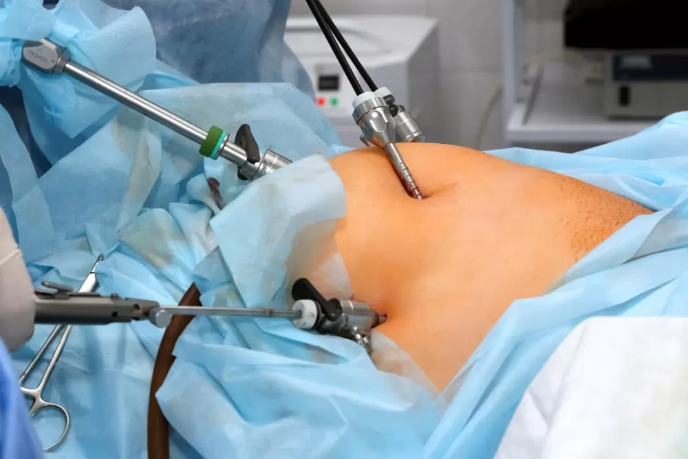 Laparoscopic Surgeries